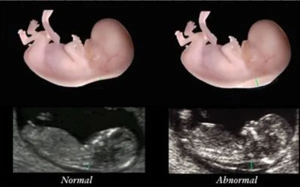 Difference Between Normal And Abnormal Nuchal Translucency